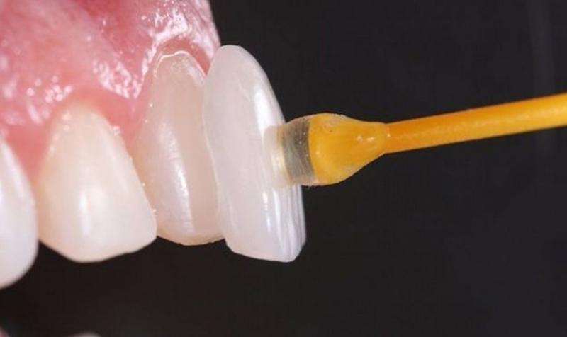 Dán răng sứ Veneer là gì?