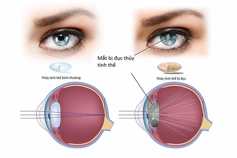 Mắt khi bị đục thủy tinh thể