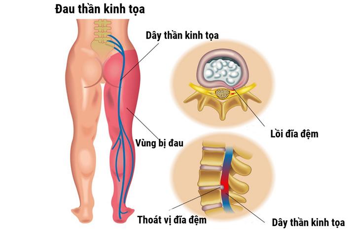 Đau thần kinh tọa