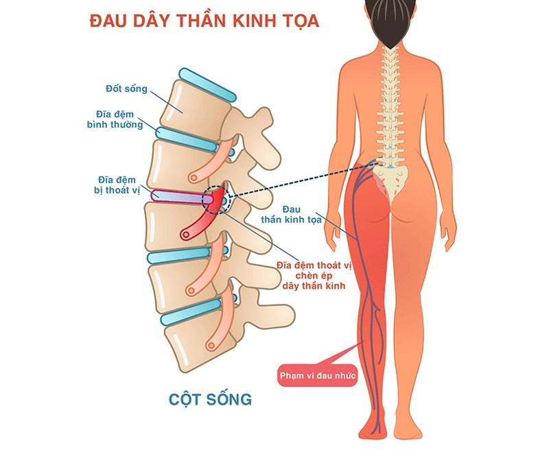 Đau thần kinh tọa