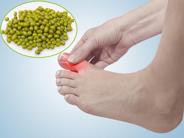Chữa bệnh gút bằng đậu xanh