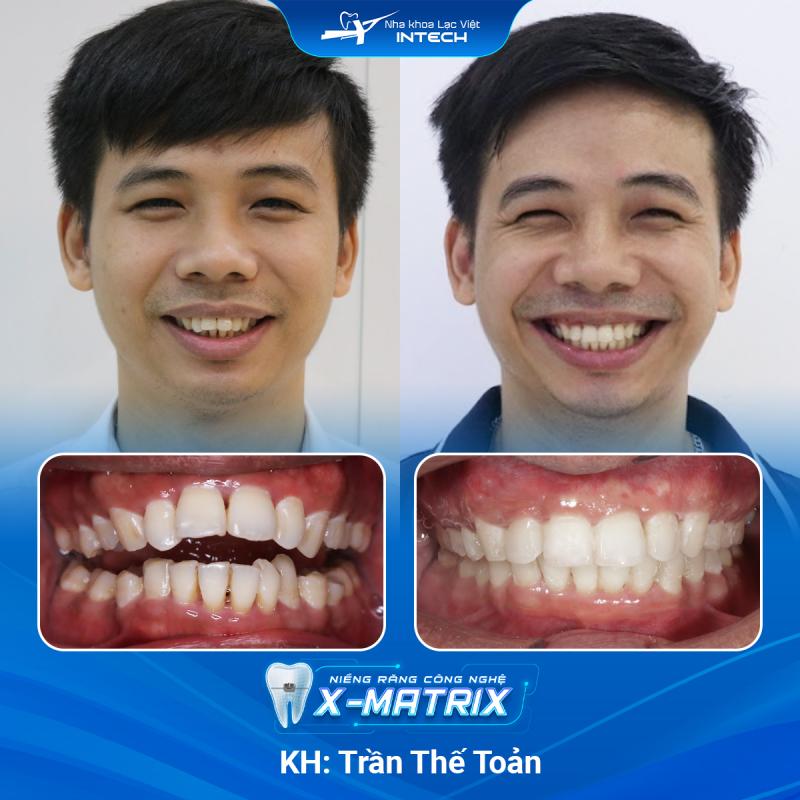 Ảnh trước - sau của khách hàng sau khi sử dụng dịch vụ của Nha Khoa Lạc Việt Intech