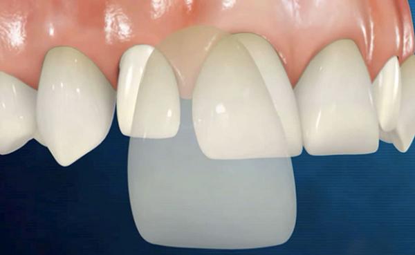 Khi nào nên đi dán sứ Veneer?