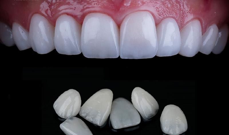 Khi nào nên đi dán sứ Veneer?