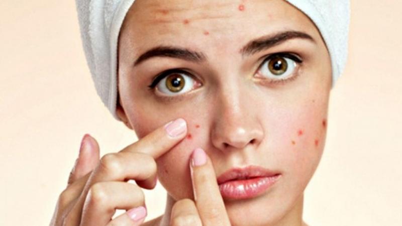 Nặn mụn gây tổn thương da và làm tình trạng mụn nghiêm trọng hơn