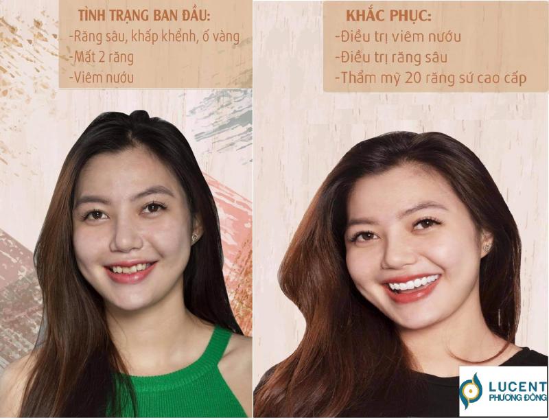 Lucent Phương Đông Nha Khoa