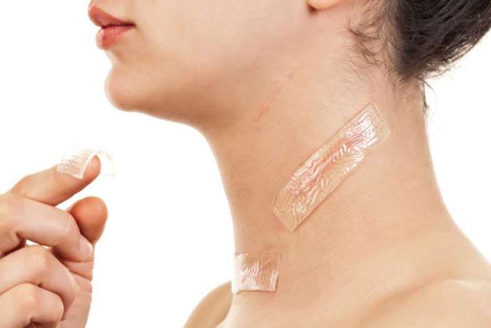 Miếng dán trị sẹo Mepiform