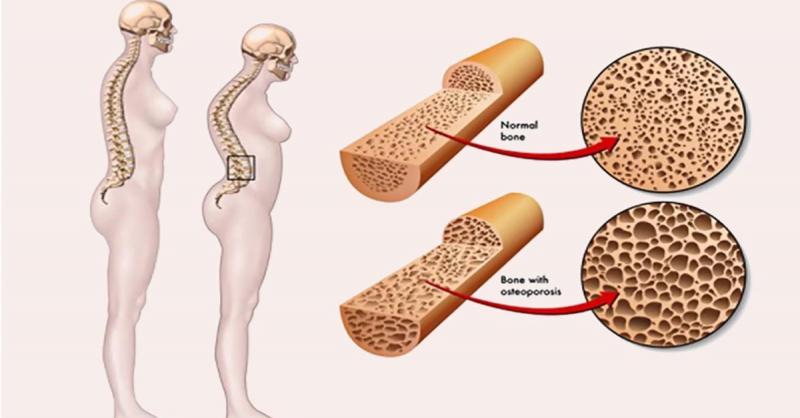 Hình ảnh minh họa bệnh loãng xương
