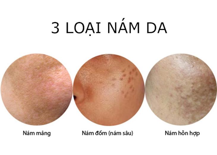 Nám da do gan hoạt động kém