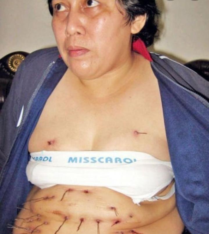 Người phụ nữ mọc ra kim loại