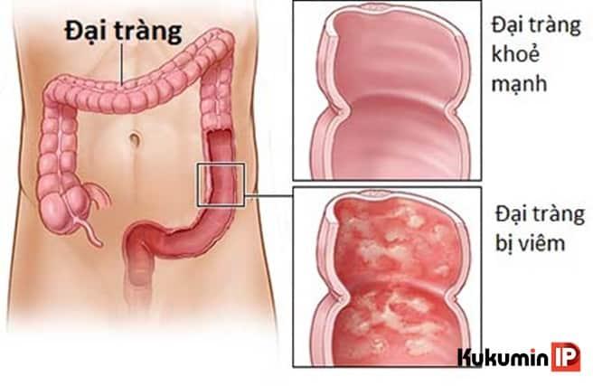 bệnh viêm ruột kết
