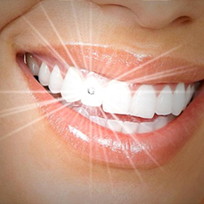 Đính đa lên răng tại Nha khoa Gia Đình