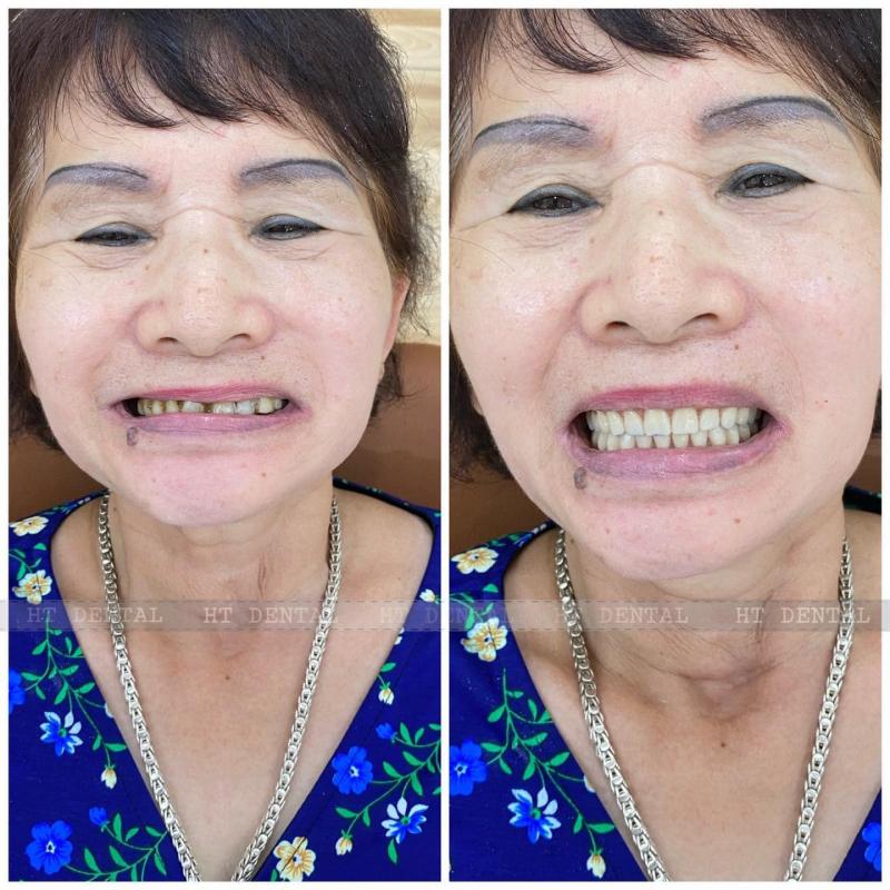 Nha Khoa HT Dental