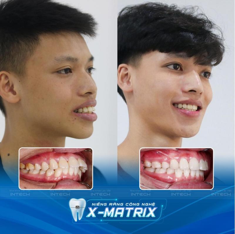 Khách hàng sau khi niềng răng bằng công nghệ X- Matrix