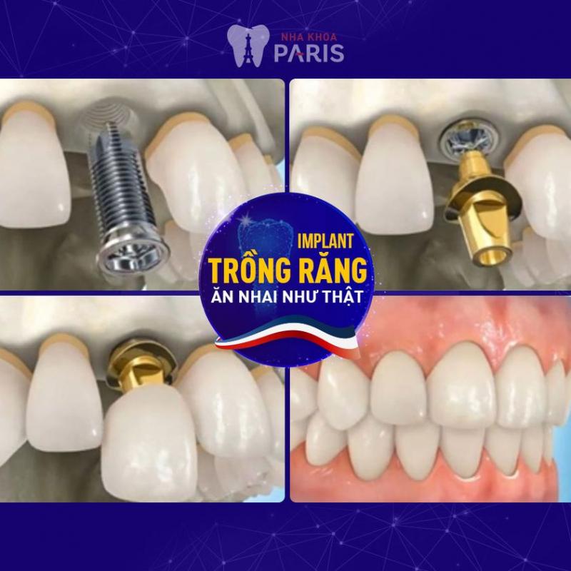 Trồng răng cửa Implant