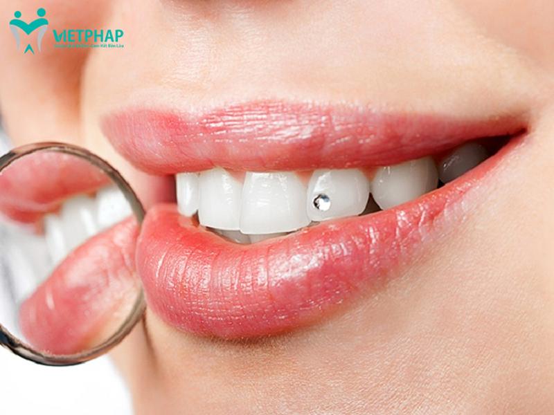 Nụ cười cuốn hút hơn khi đính đá lên răng tại nha khoa quốc tế Việt Pháp