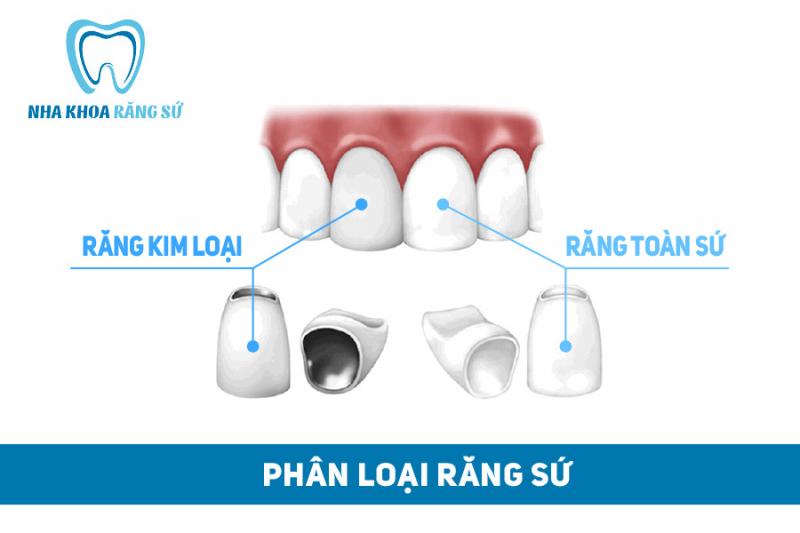 Nha Khoa Răng Sứ