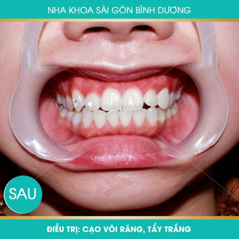 Nha khoa Sài Gòn Bình Dương