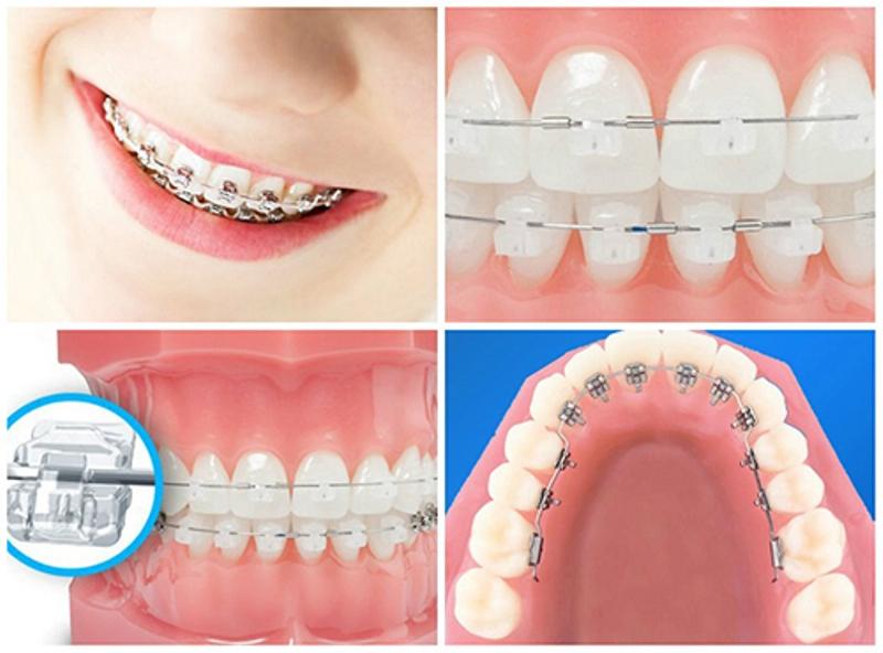 Một số kiểu niềng răng tại Nha khoa Sài Gòn Đà Nẵng