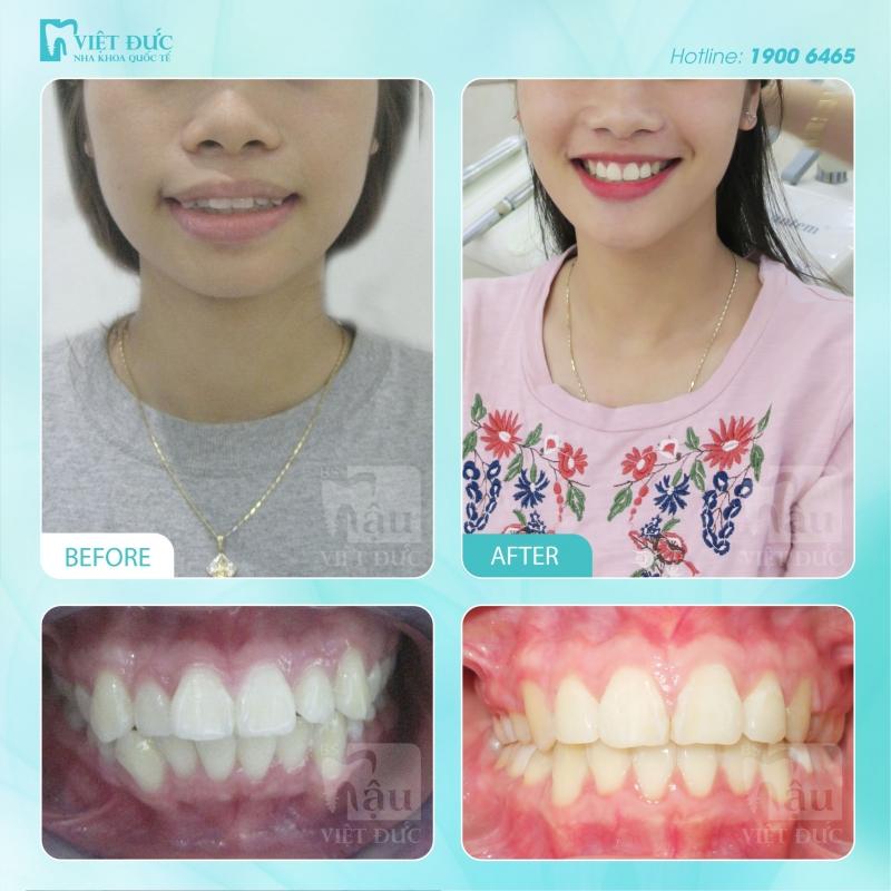 Hình ảnh khách hàng trước và sau niềng răng tại Việt Đức