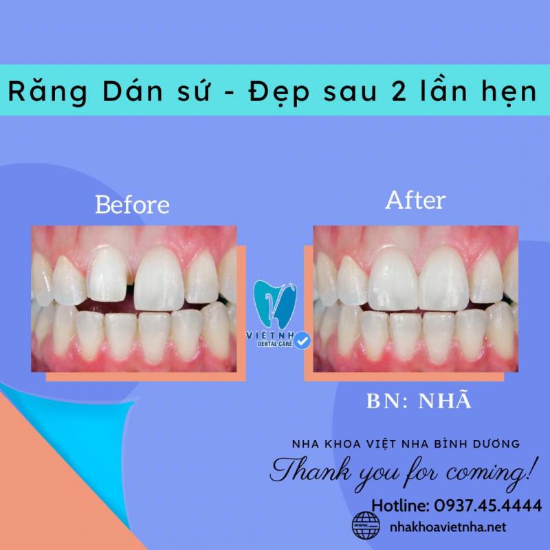 Nha khoa Việt Nha Bình Dương