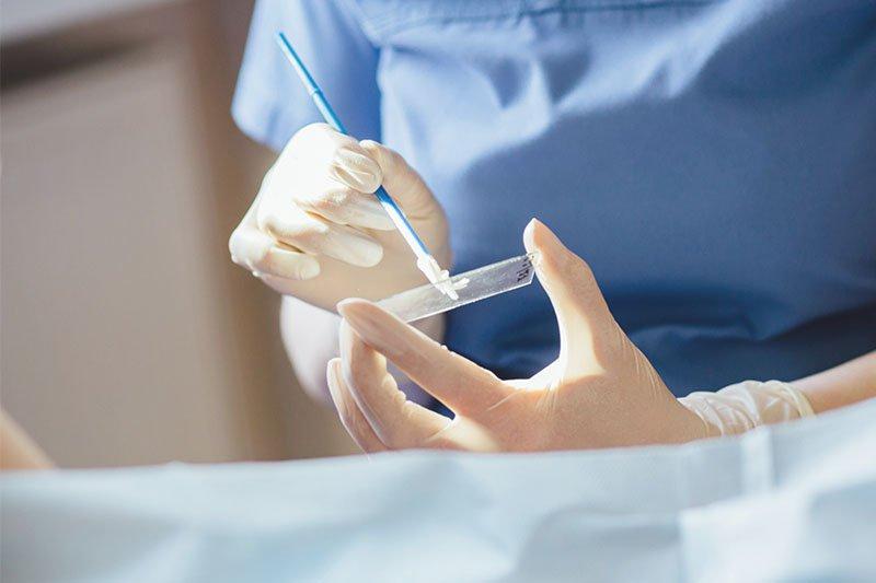 Xét nghiệm ung thư cổ tử cung bằng xét nghiệm PAP smear