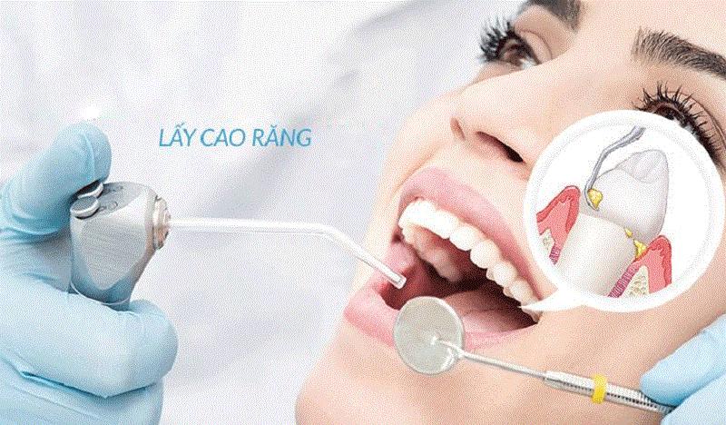 Lấy cao răng trước khi tẩy trắng răng