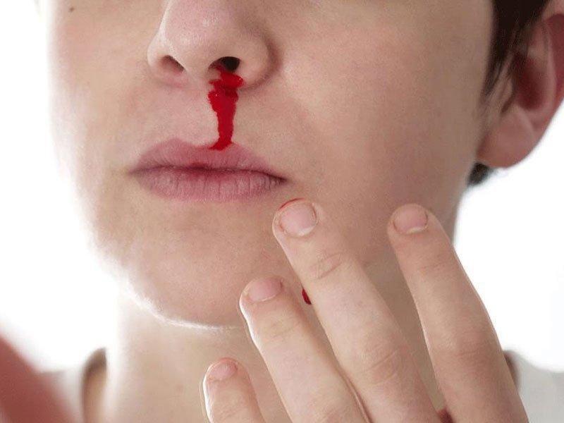 Có những cấp độ chảy máu cam nào?