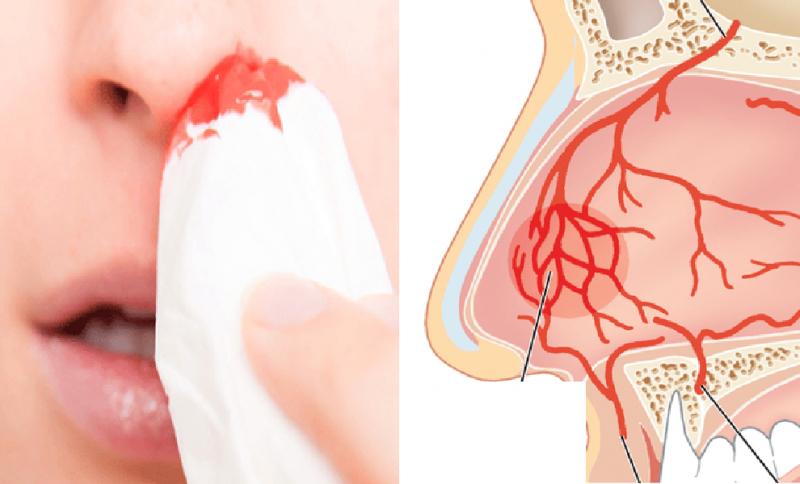 Có những cấp độ chảy máu cam nào?