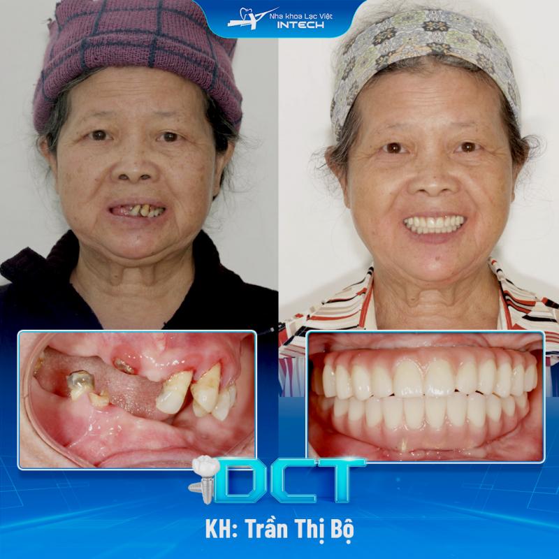 Kết quả trồng răng Implant của khách hàng thực tại nha khoa Lạc Việt Intech.
