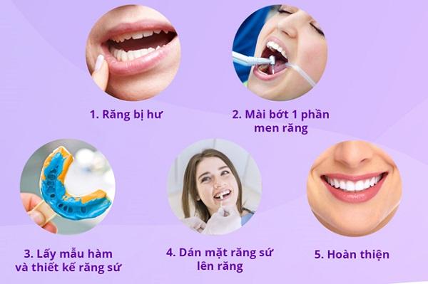 Quy trình dán sứ Veneer