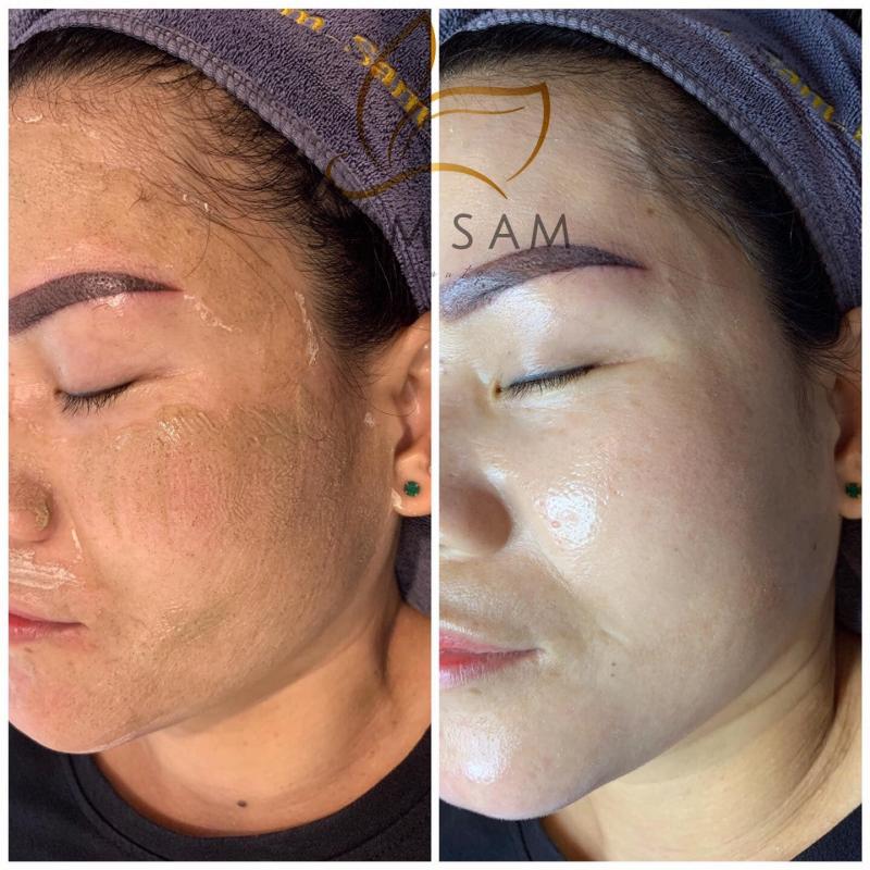 Sam Sam Beauty - Viện chăm sóc da chuyên điều trị mụn, nám, sẹo rổ.