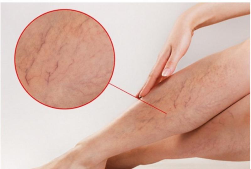 SC-ON CX+ hỗ trợ duy trì lưu thông tĩnh mạch, ngăn ngừa suy giãn tĩnh mạch hiệu quả