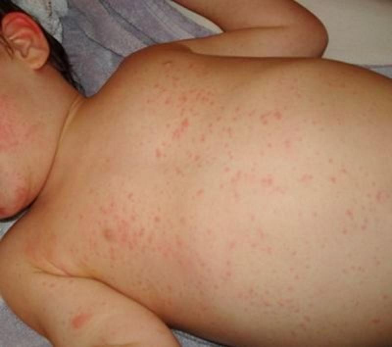Sốt phát ban gây mẩn đỏ khắp người trẻ