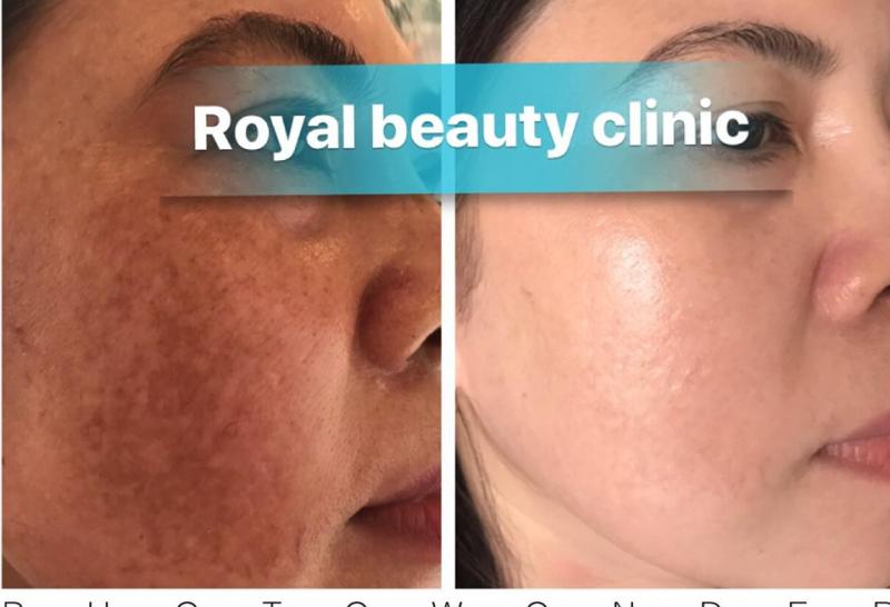 Điều trị nám tại Spa Beauty Royal Quy nhơn