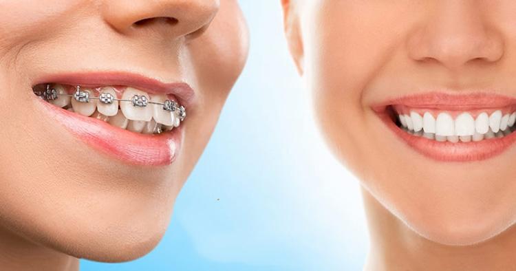 Thời gian niềng răng bằng vật liệu 3M
