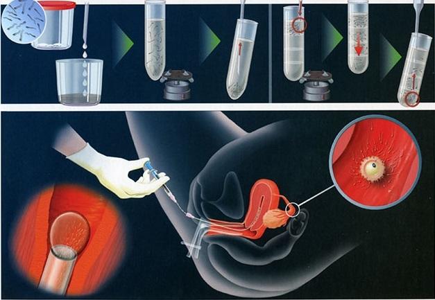 Quá trình thực hiện thụ tinh nhân tạo