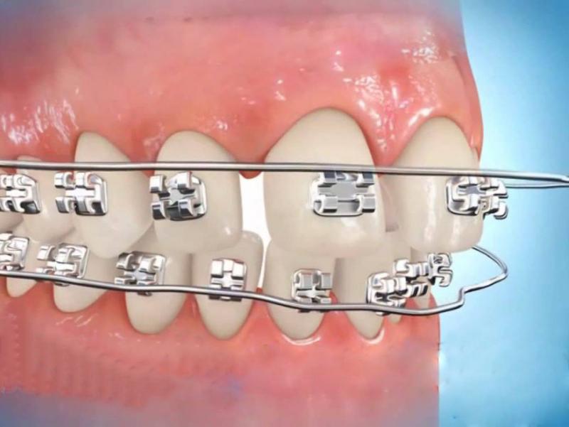 Tổng quan về niềng răng bằng vật liệu 3M